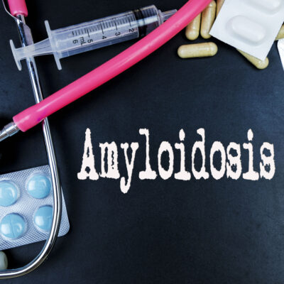 Amyloidosis &#8211; warning symptoms and treatment options